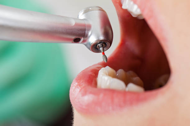 Best Emergency Wisdom Teeth Removal in Spring Valley, MN